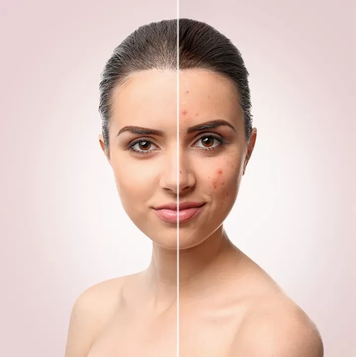 Acne treatment patient with brown hair