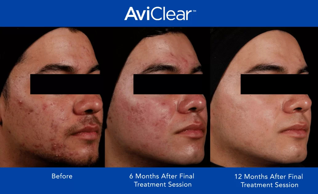 Before and Afters of an Acne Patient