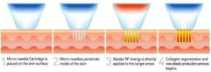 Facial Rejuvenation With RF Microneedling With Pixel8