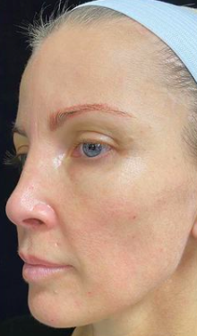 Liquid Facelift Before & After Image