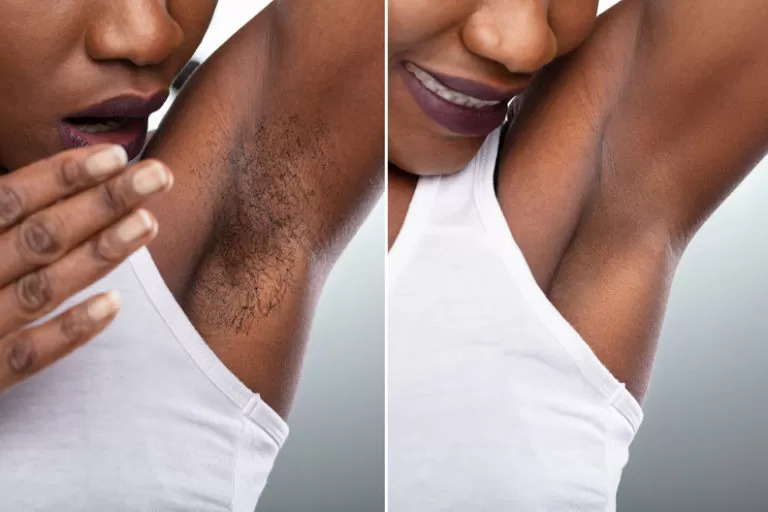 Laser Hair Removal For All Skin Tones, Including African American Skin 