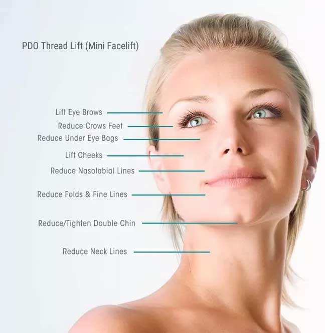PDO Thread Lift (Mini Facelift) Before And After Photos
