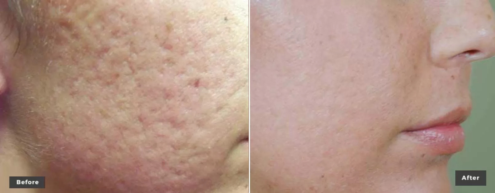 Laser Genesis Facial Skin Tone & Scar Removal