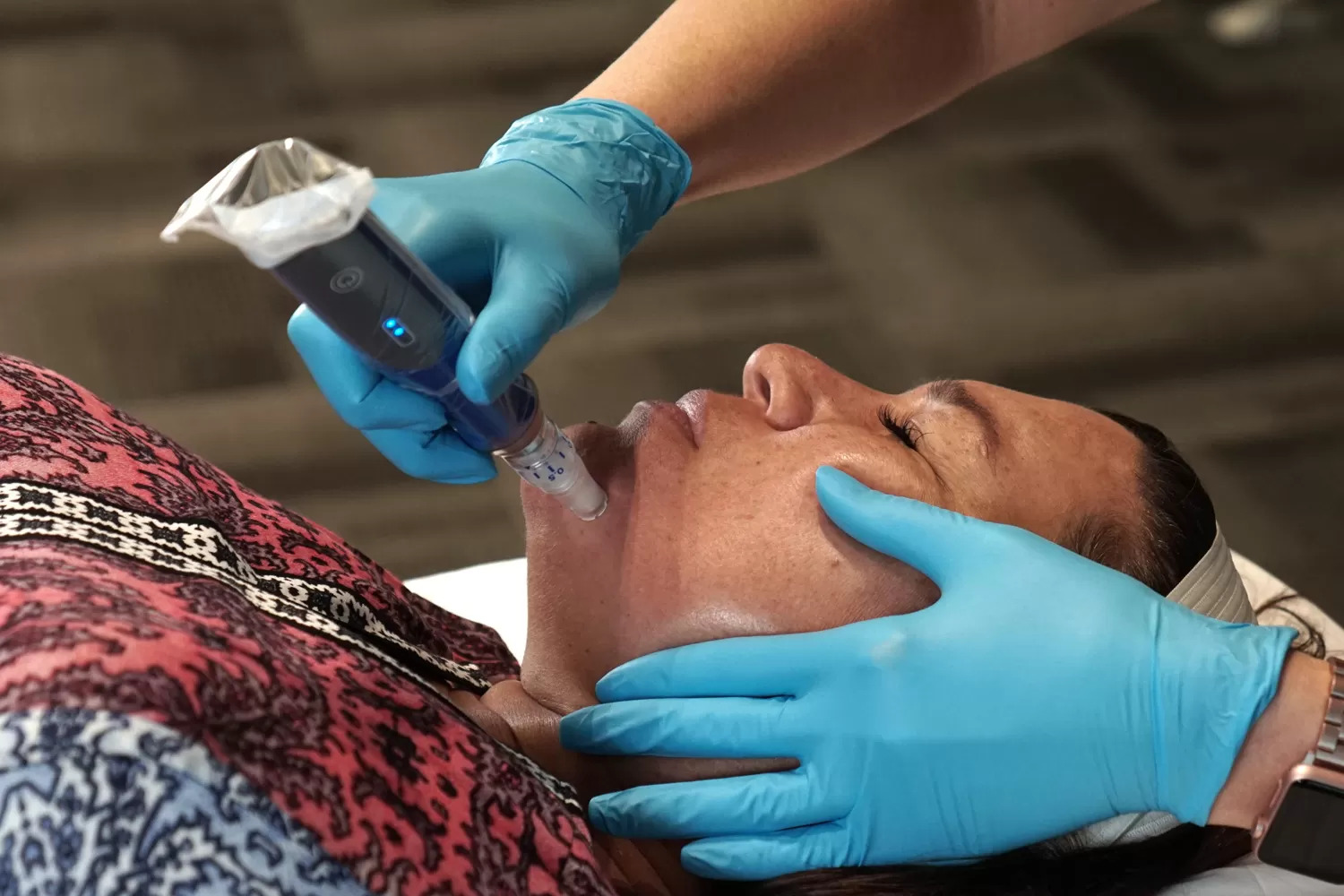 Facial Rejuvenation With SkinPen Microneedling