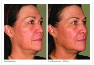 Ultherapy – Non-Invasive Skin Tightening Before And After Photos