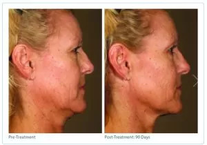 Ultherapy – Non-Invasive Skin Tightening Before And After Photos