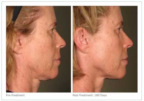 How Much Does Ultherapy – Non-Invasive Skin Tightening & Lifting Treatment Cost?