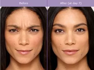 Botox Injections Before And After Photos