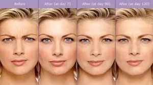 How Much Do Botox Injections Cost?