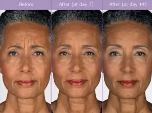 Botox Injections Before And After Photos