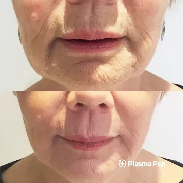 Plasma Pen Non-Surgical Face Contouring to Remove Lines And Wrinkles