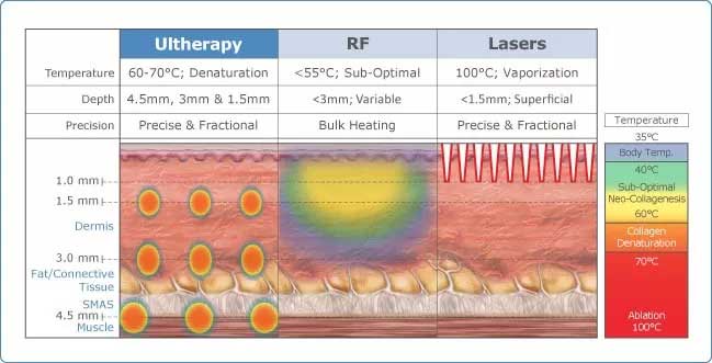 What is Ultherapy – Non-Invasive Skin Tightening?