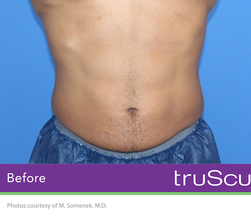 truSculpt Flex Before & After Image