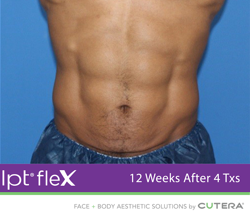 truSculpt Flex Before & After Image