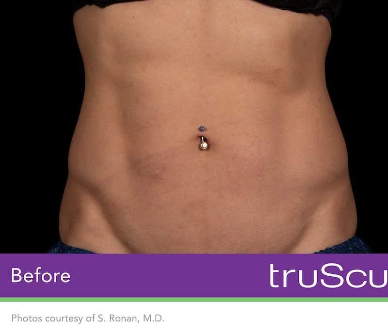 truSculpt Flex Before & After Image