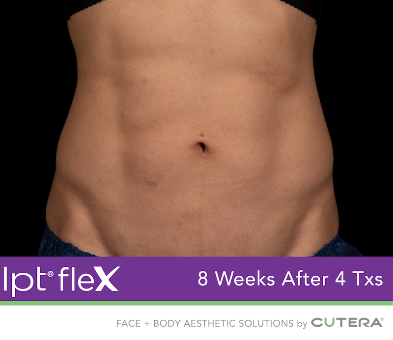 truSculpt Flex Before & After Image