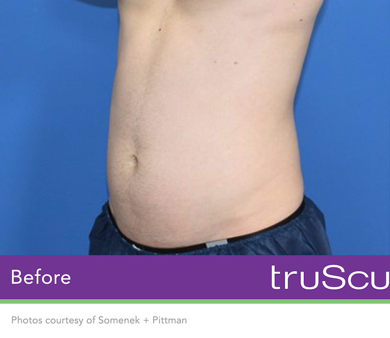 truSculpt Flex Before & After Image