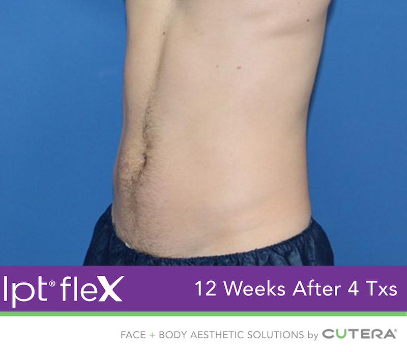 truSculpt Flex Before & After Image