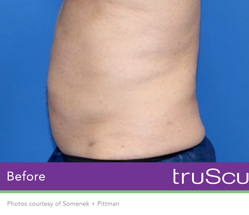 truSculpt Flex Before & After Image