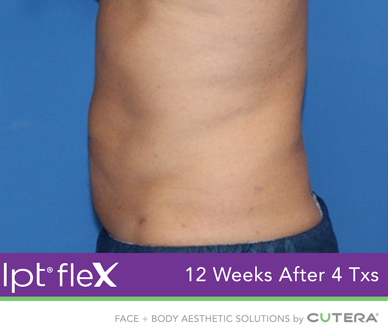 truSculpt Flex Before & After Image