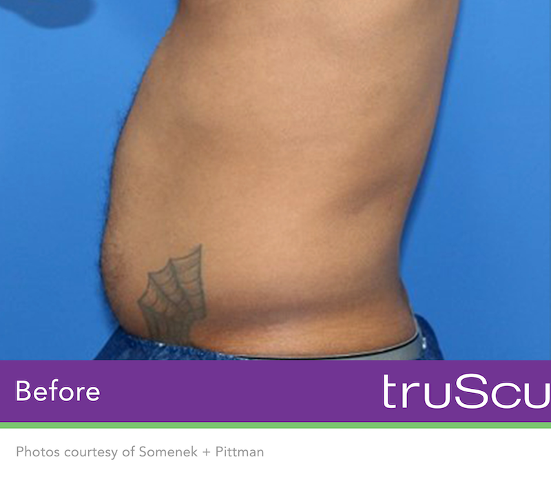 truSculpt Flex Before & After Image