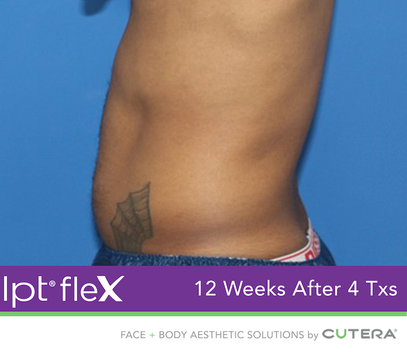 truSculpt Flex Before & After Image