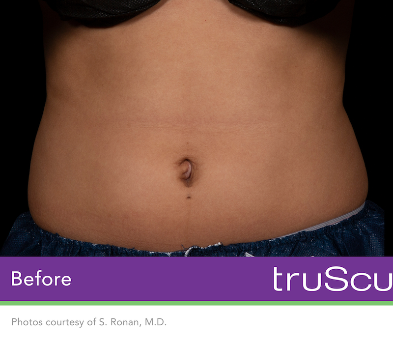 truSculpt Flex Before & After Image