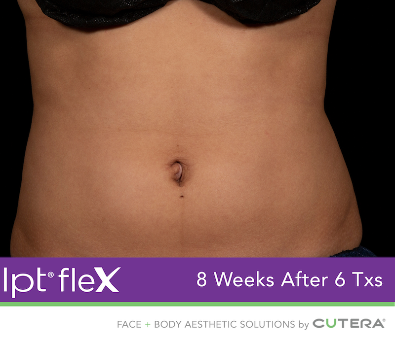 truSculpt Flex Before & After Image