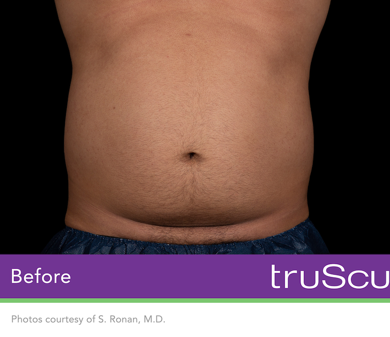 truSculpt Flex Before & After Image