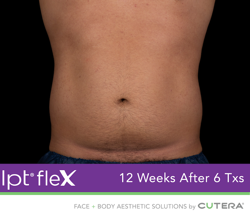 truSculpt Flex Before & After Image