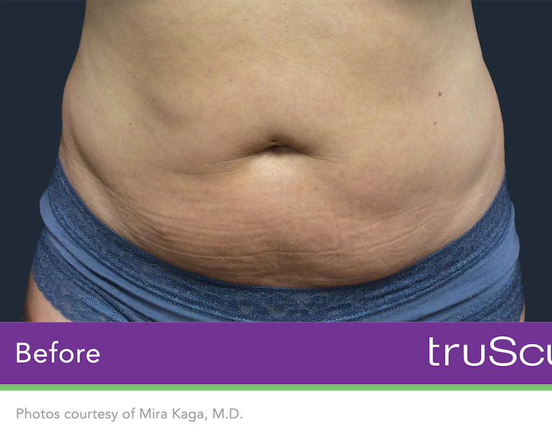 truSculpt iD Before & After Image