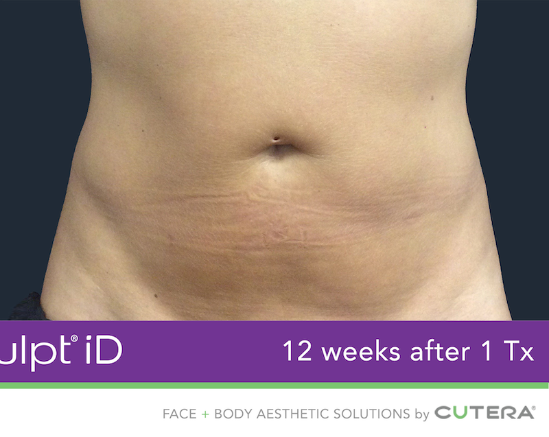 truSculpt iD Before & After Image