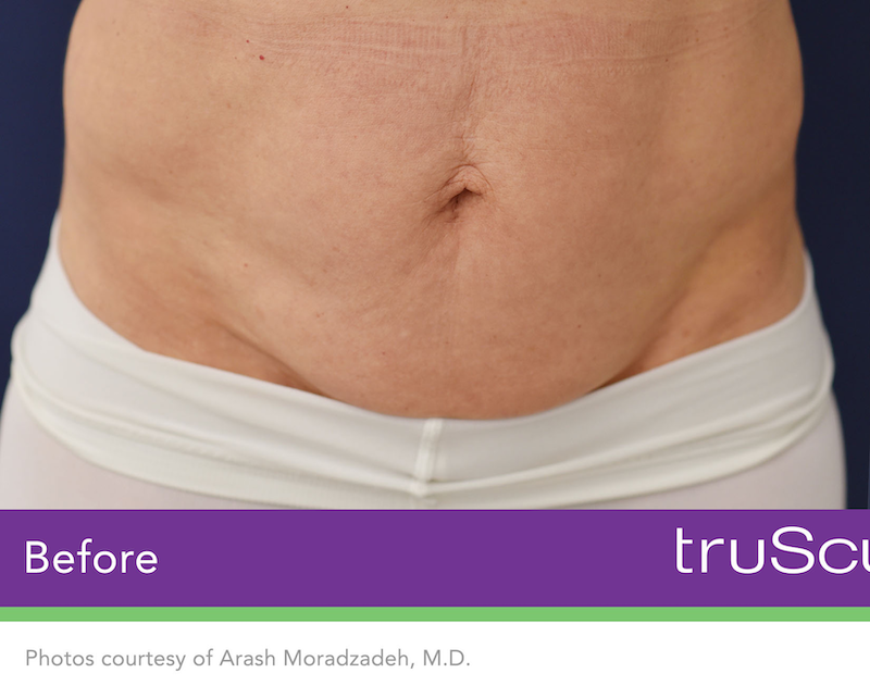 truSculpt iD Before & After Image