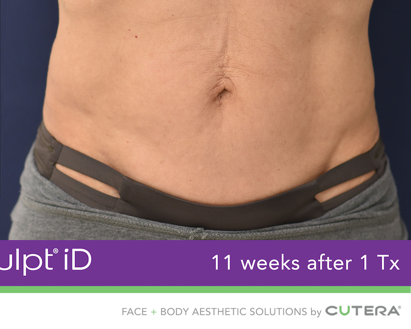 truSculpt iD Before & After Image