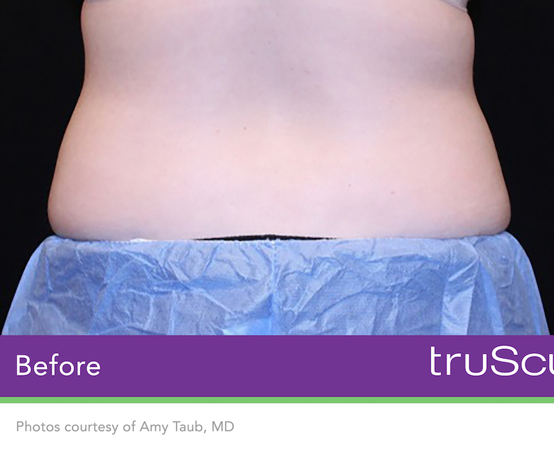 truSculpt iD Before & After Image