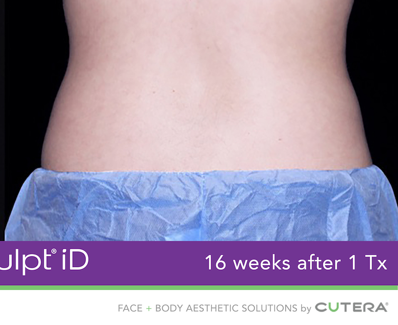 truSculpt iD Before & After Image