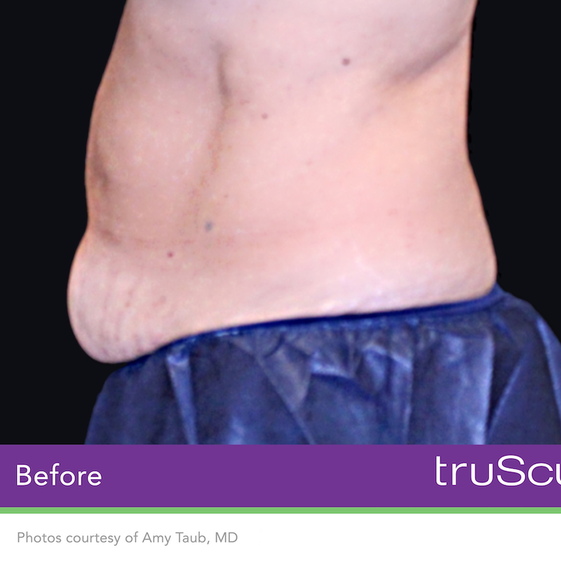 truSculpt iD Before & After Image