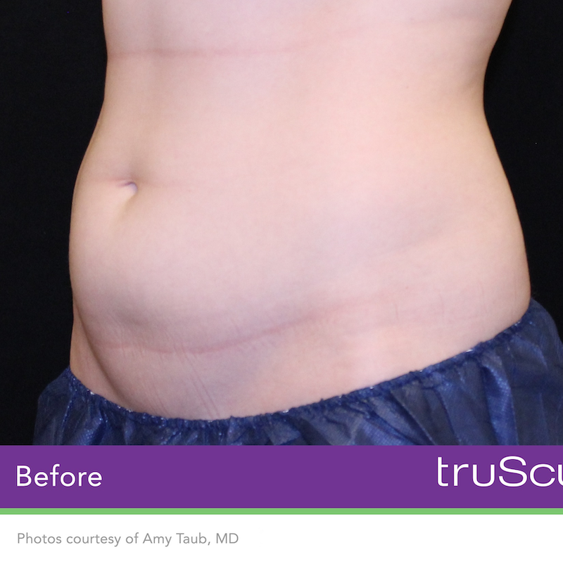 truSculpt iD Before & After Image