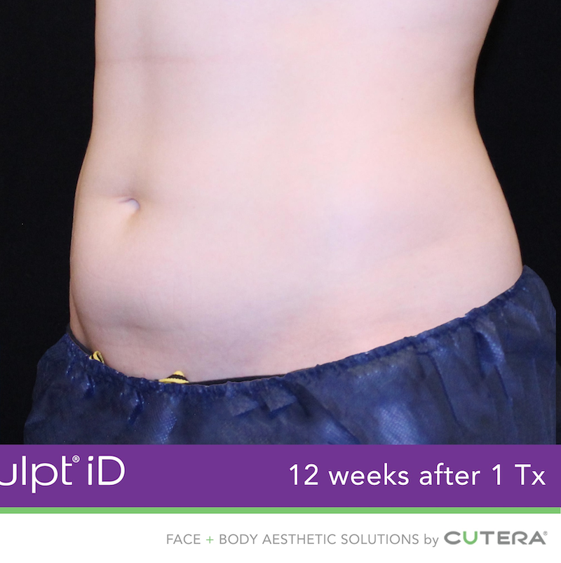 truSculpt iD Before & After Image