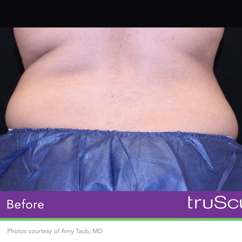 truSculpt iD Before & After Image