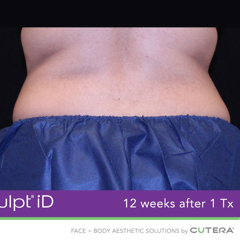 truSculpt iD Before & After Image