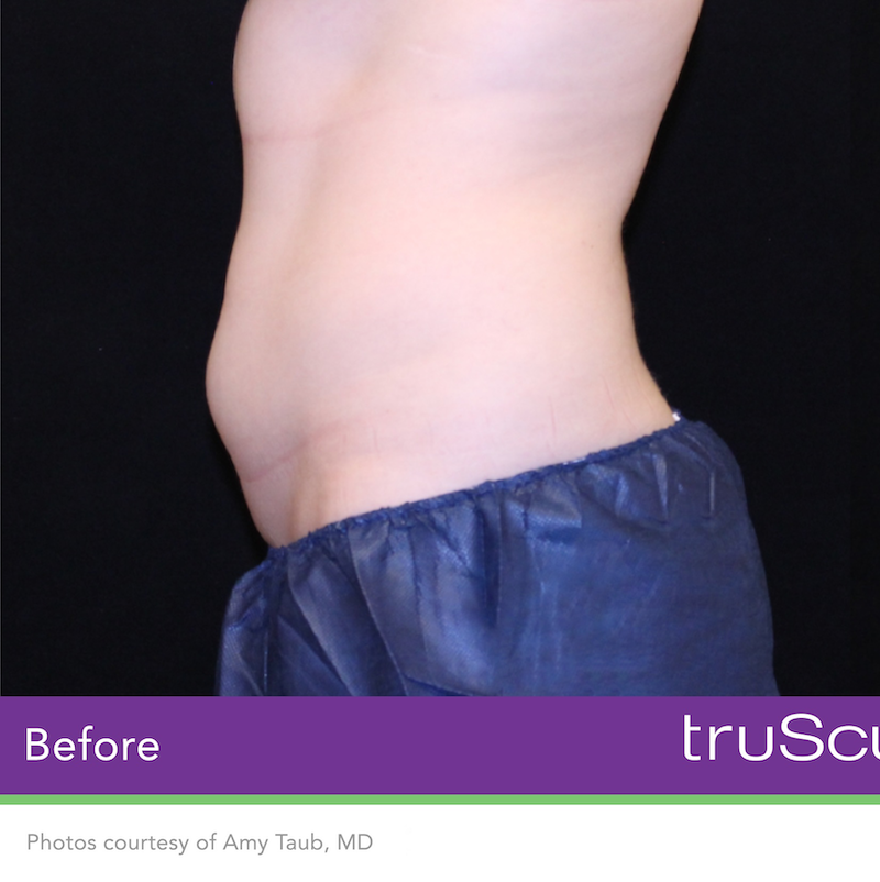 truSculpt iD Before & After Image