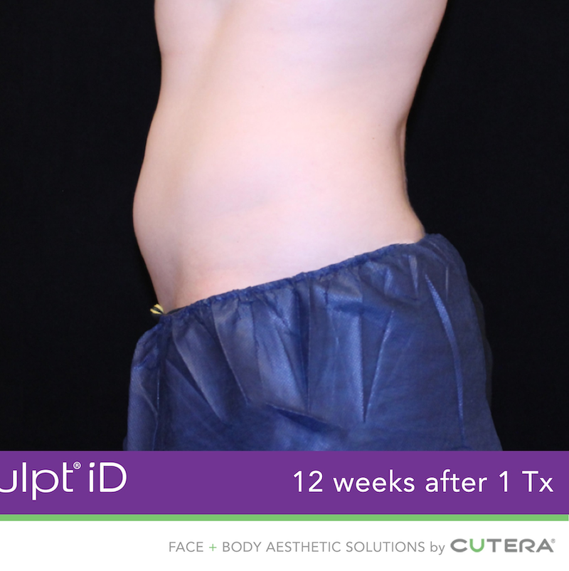 truSculpt iD Before & After Image