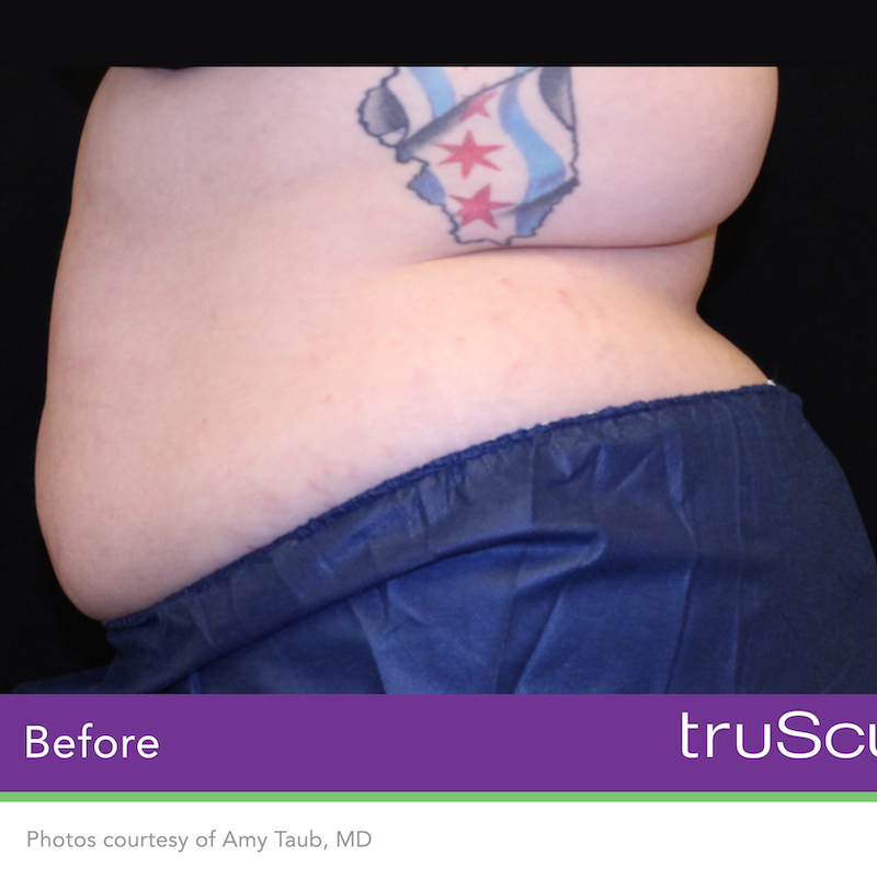 truSculpt iD Before & After Image