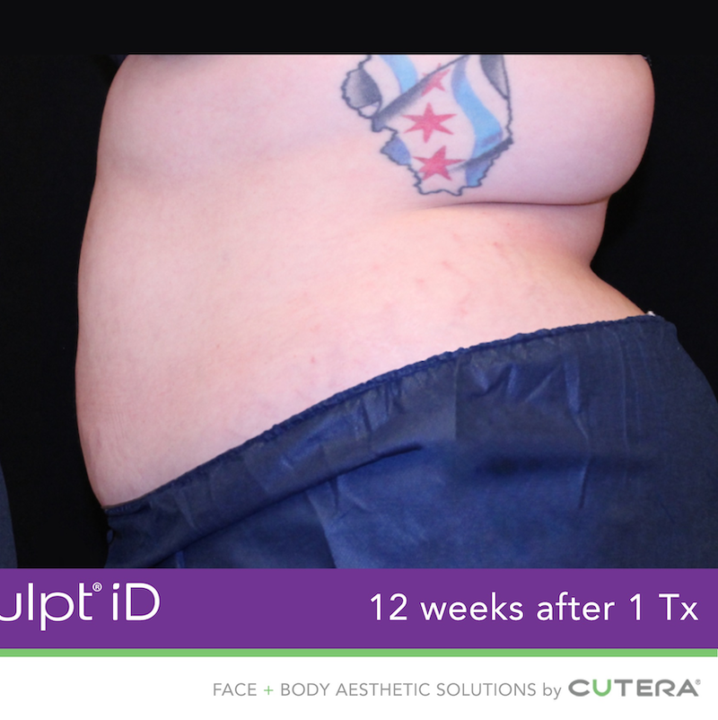 truSculpt iD Before & After Image