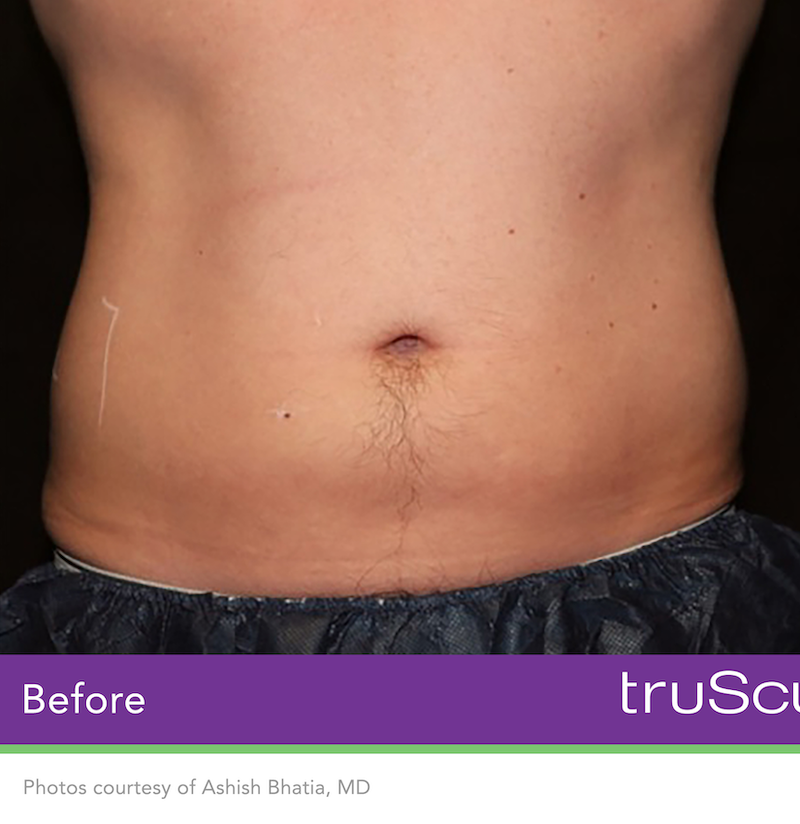 truSculpt iD Before & After Image