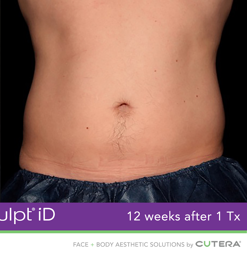 truSculpt iD Before & After Image