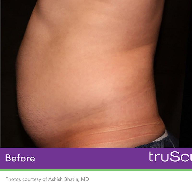 truSculpt iD Before & After Image