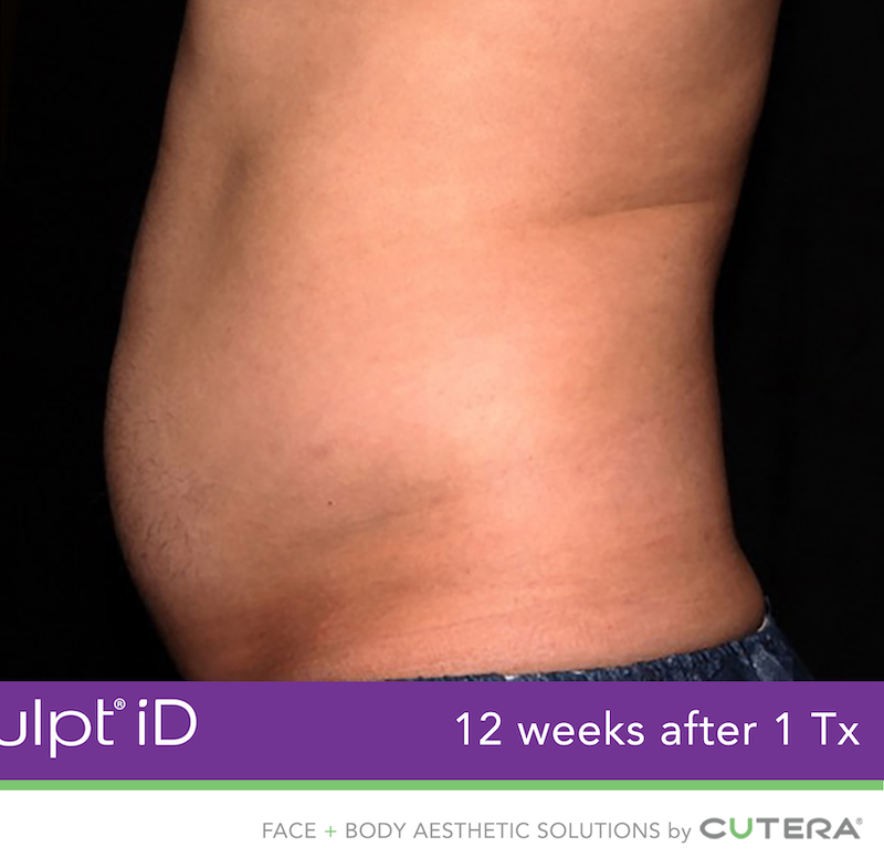 truSculpt iD Before & After Image