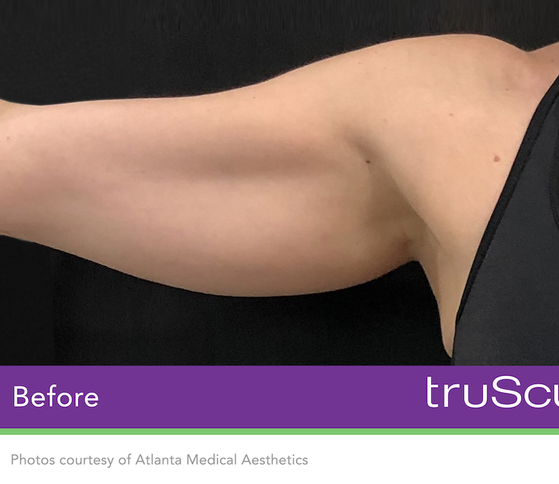 truSculpt iD Before & After Image